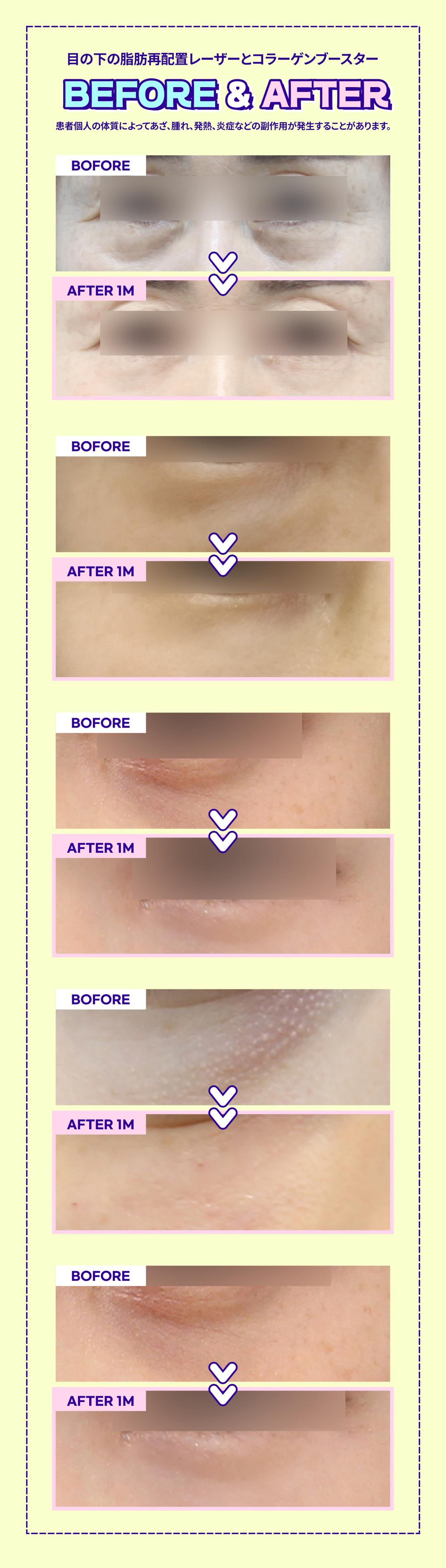 Cải thiện quầng thâm・mỡ dưới mắt Laser sóng cao tần + Filler Collagen hướng tới vùng mắt trẻ trung | Gangnam Jfeel Clinic