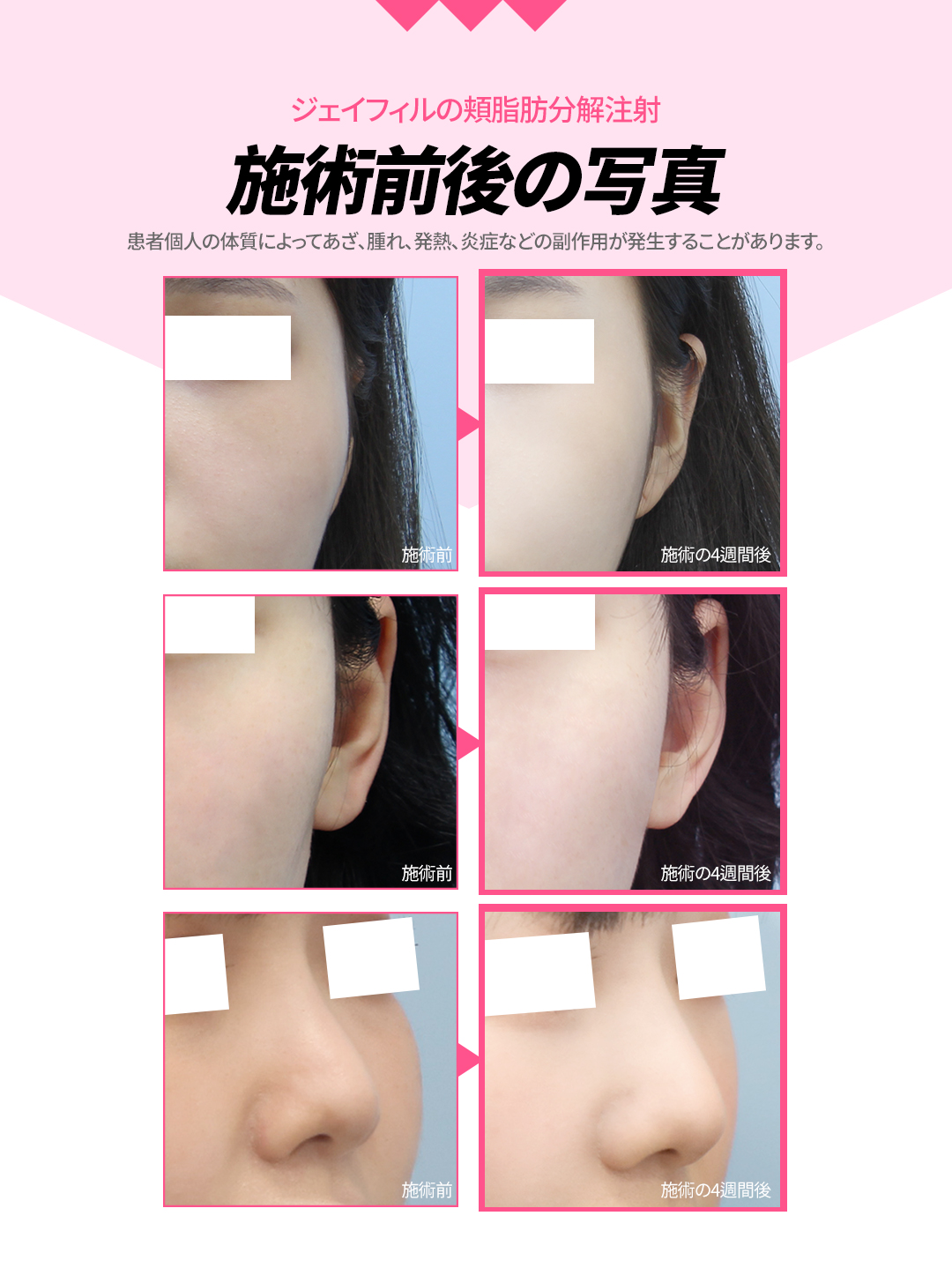 Tiêm phân giải mỡ má tạo đường mặt nhỏ | Công thức không steroid | J Feel Gangnam