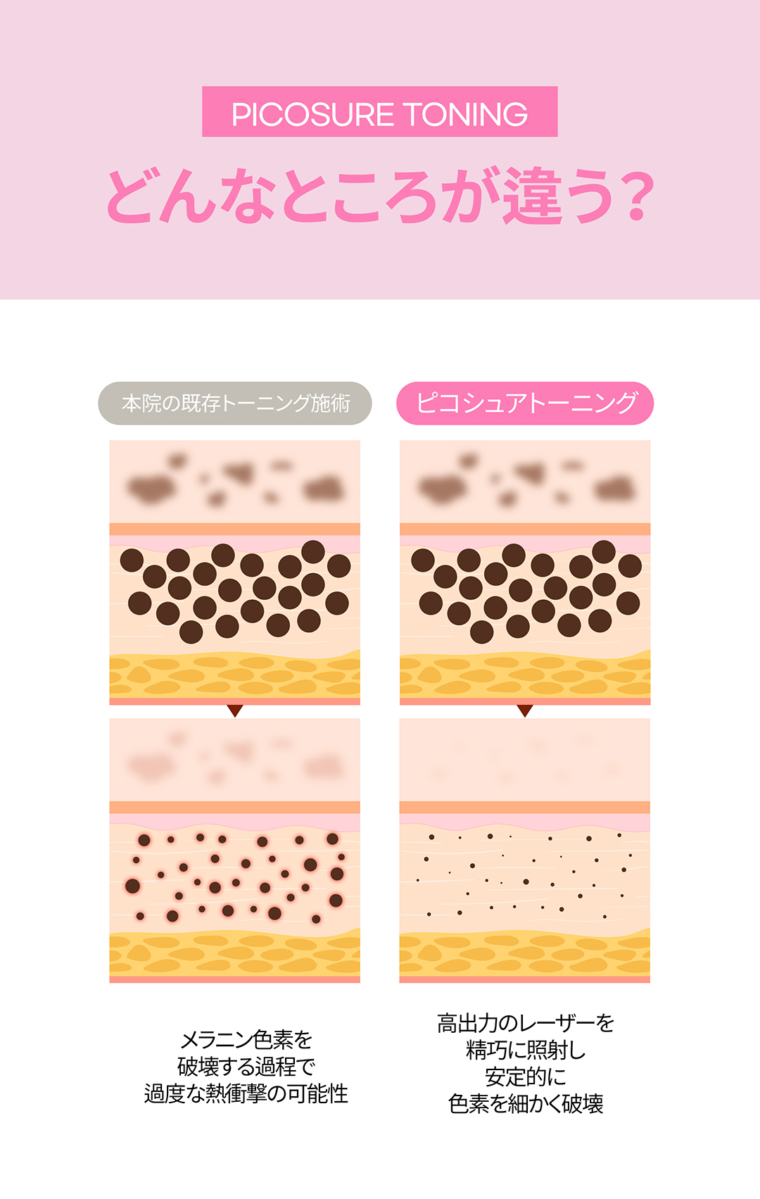 Pico Toning Gangnam | Laser cải thiện sắc tố và xỉn màu để có làn da trong suốt - Phòng khám Jfeel