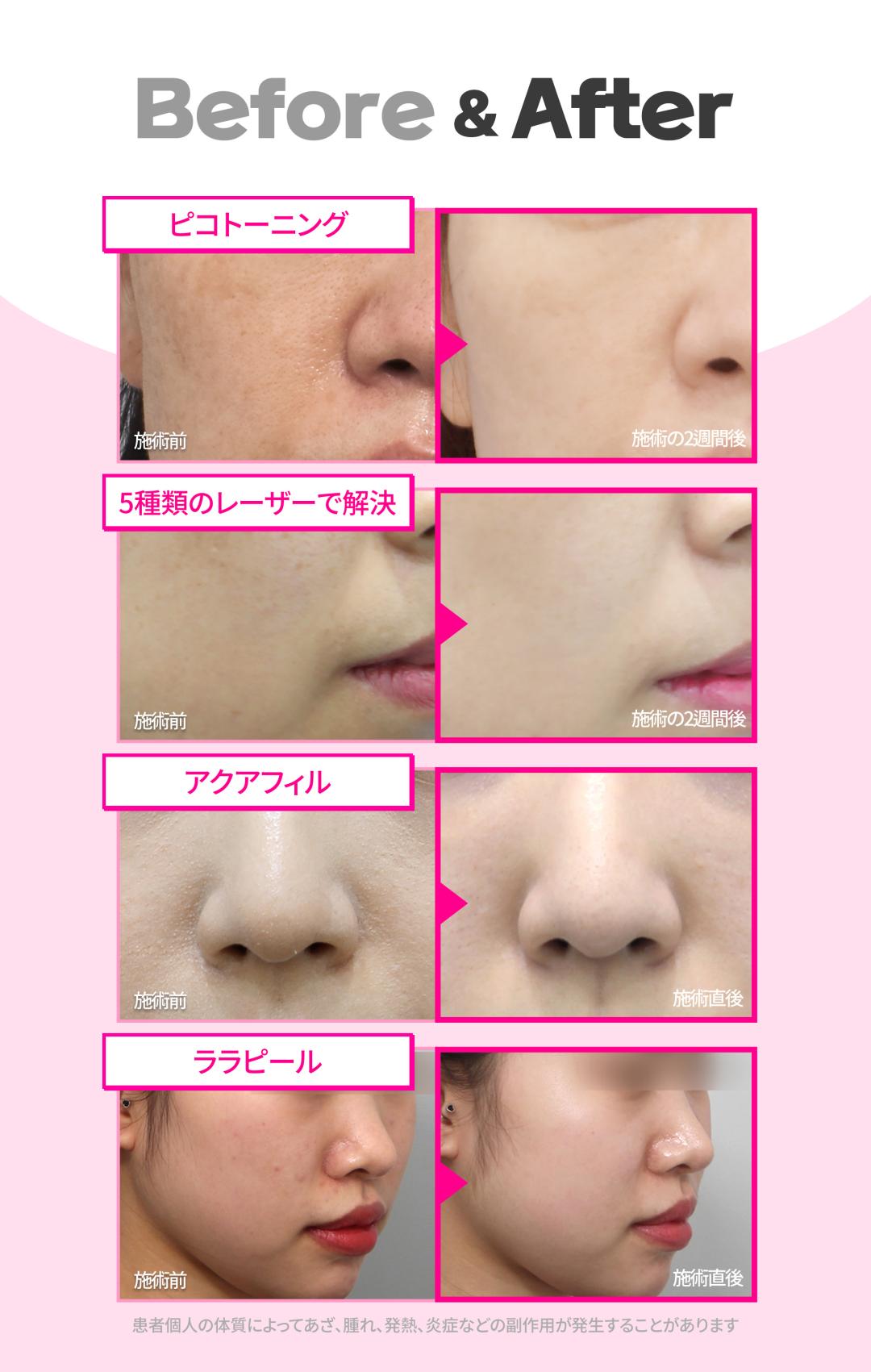 Pico Toning Gangnam | Laser cải thiện sắc tố và xỉn màu để có làn da trong suốt - Phòng khám Jfeel