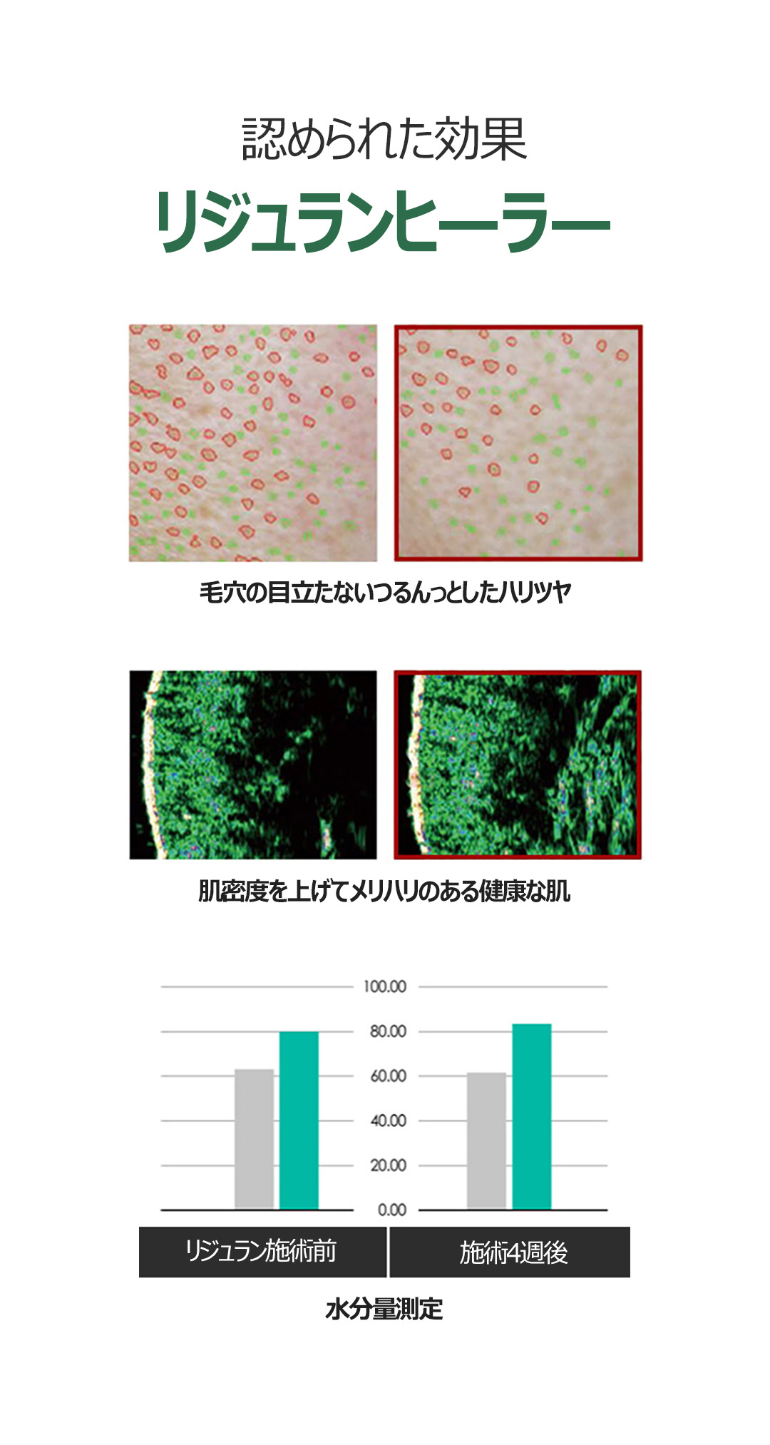 【Rejuran Healer 2cc dưới gây mê ngủ】Liệu pháp tiếp cận khả năng tái tạo da, mang đến làn da căng bóng