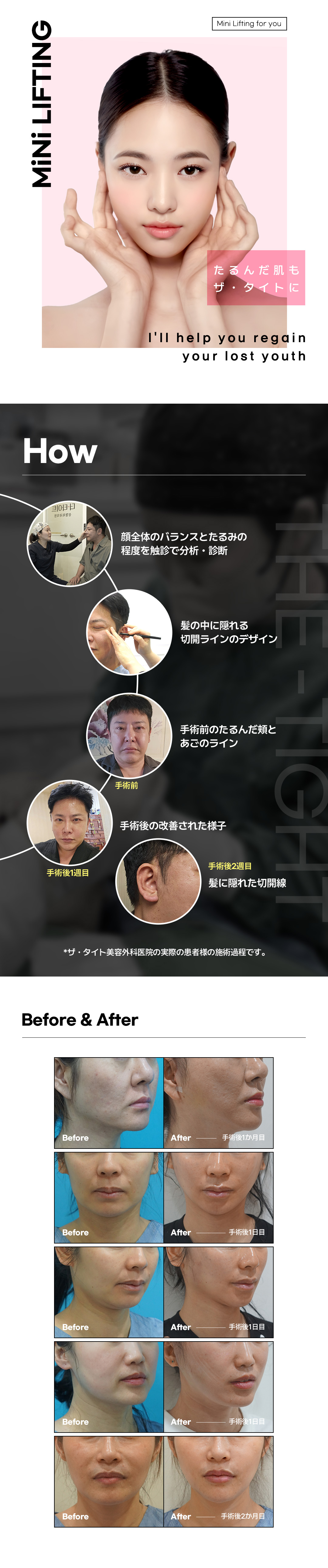 Mini Face Lift | Phẫu thuật nâng cơ cải thiện chảy xệ cho độ tuổi 20-40 | The Tight Clinic (Gangnam Seoul)