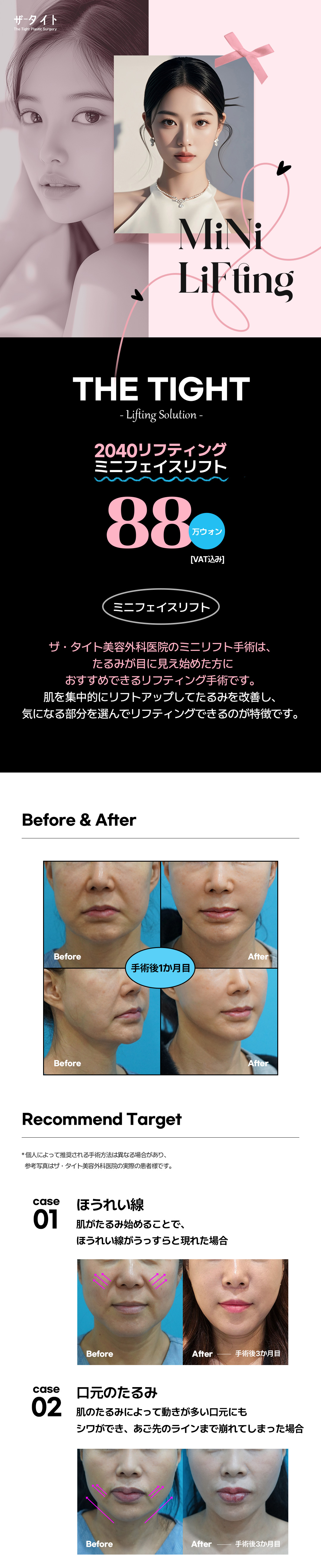Mini Face Lift | Phẫu thuật nâng cơ cải thiện chảy xệ cho độ tuổi 20-40 | The Tight Clinic (Gangnam Seoul)