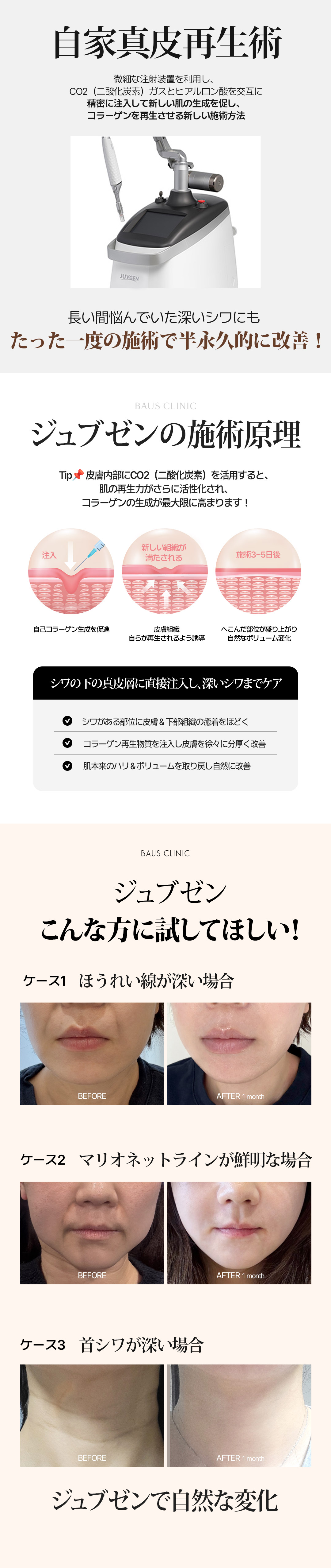 Hiệu quả bán vĩnh viễn - Phẫu thuật tái tạo chân bì tự thân Jubzen_Hiệu quả căng, tăng volume, tạo collagen_Làn da trẻ trung khỏe mạnh bằng mô của chính mình_Áp dụng cho nếp nhăn rãnh mũi miệng, trán, cổ