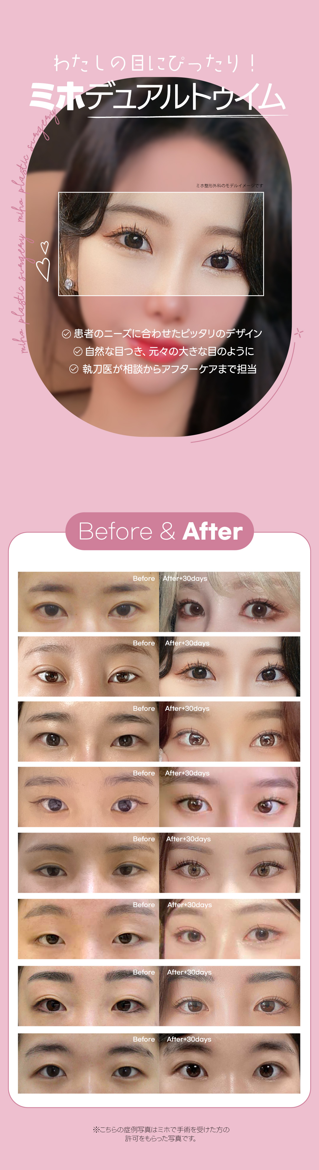 Dual Teuim cắt đuôi mắt + Tạo mắt cụp | Hướng tới đôi mắt kiểu chó con・mèo con | Phòng khám Miho Thẩm mỹ