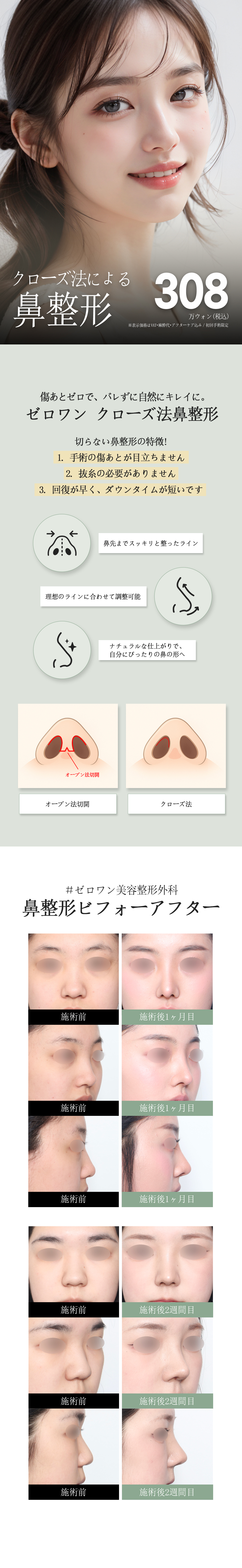 Nâng mũi phương pháp đóng | Nâng mũi không cắt sẹo khó thấy・giảm thời gian hồi phục | Seoul Gangnam Zero One Phẫu thuật Tạo hình Thẩm mỹ