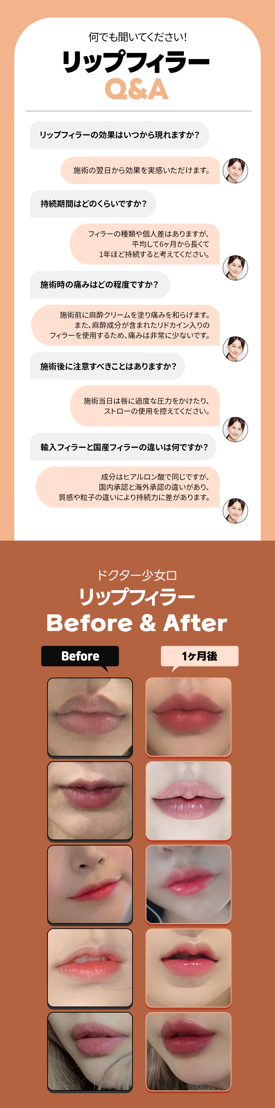 Filler môi Belotero | Liệu trình môi kỳ vọng tăng volume tự nhiên | Dr. Sonyoro Phòng khám