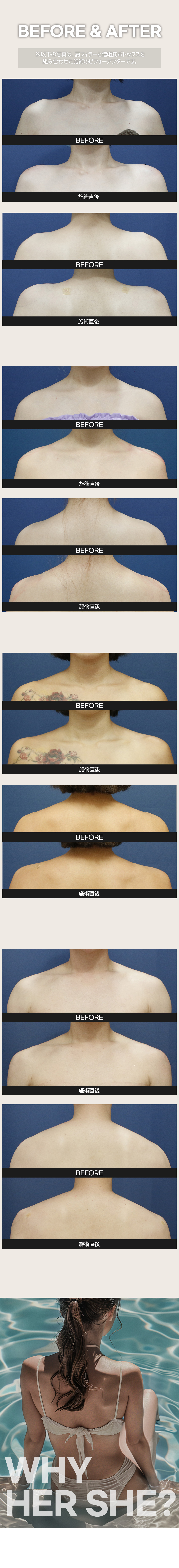 Botox vai & Botox cổ thon 100unit 11.909 yên｜Thu gọn cơ thang điều chỉnh đường vai｜Phẫu thuật Thẩm mỹ HERSHE