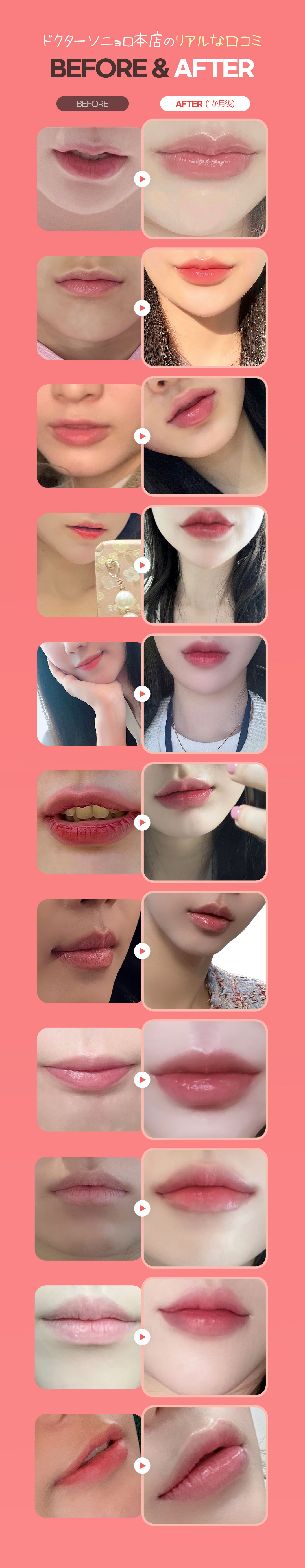 Filler môi Juvederm・Restylane Kiss｜Hướng đến môi tự nhiên với tỷ lệ vàng｜Phòng khám Doctor Sonyeoro Apgujeong Seoul