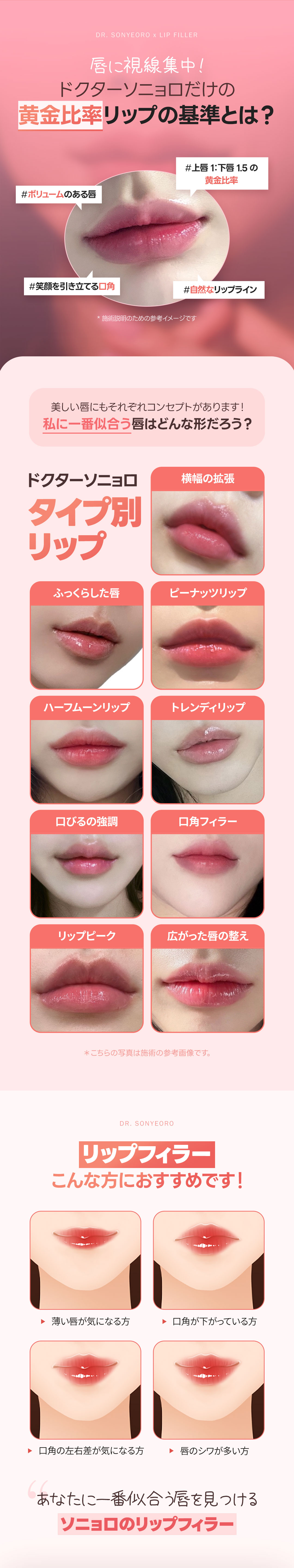 Filler môi Juvederm・Restylane Kiss｜Hướng đến môi tự nhiên với tỷ lệ vàng｜Phòng khám Doctor Sonyeoro Apgujeong Seoul