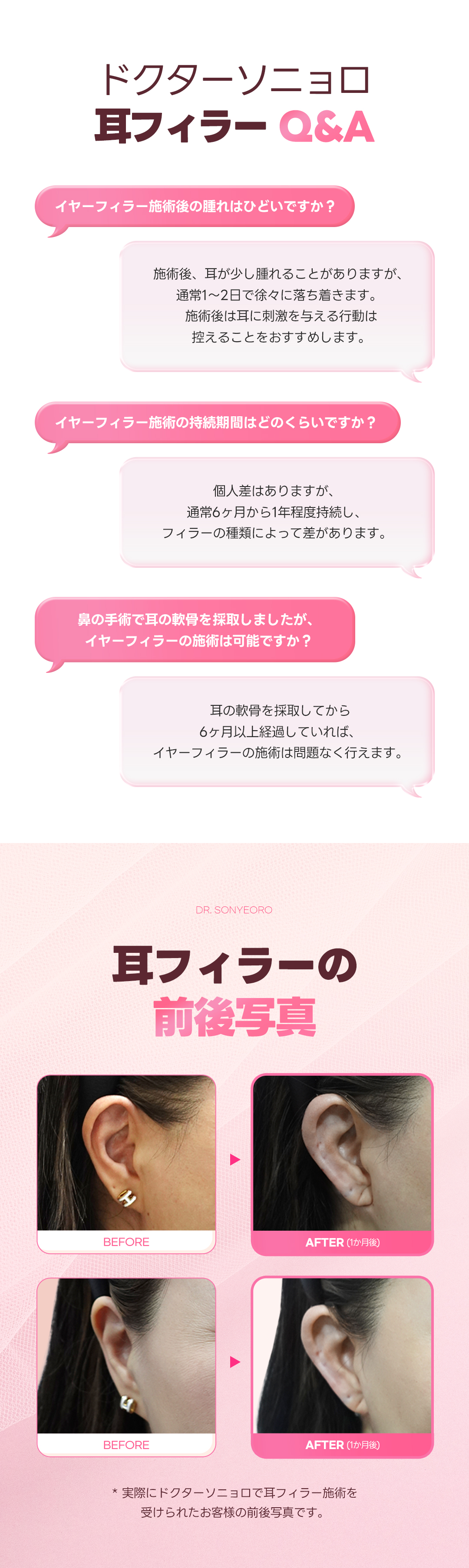 Hướng đến hiệu quả mặt nhỏ với filler tai | Kết nối trực tiếp ga Apgujeong - Dr. Sonyoro Phòng khám【550,000 won không phí phát sinh】