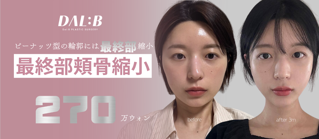 Phẫu thuật thu nhỏ gò má Dalbi Thẩm mỹ Hàn Quốc｜Tạo hình đường viền an toàn với phân tích 3D-CT・Cách ga Sinsa 3 phút đi bộ