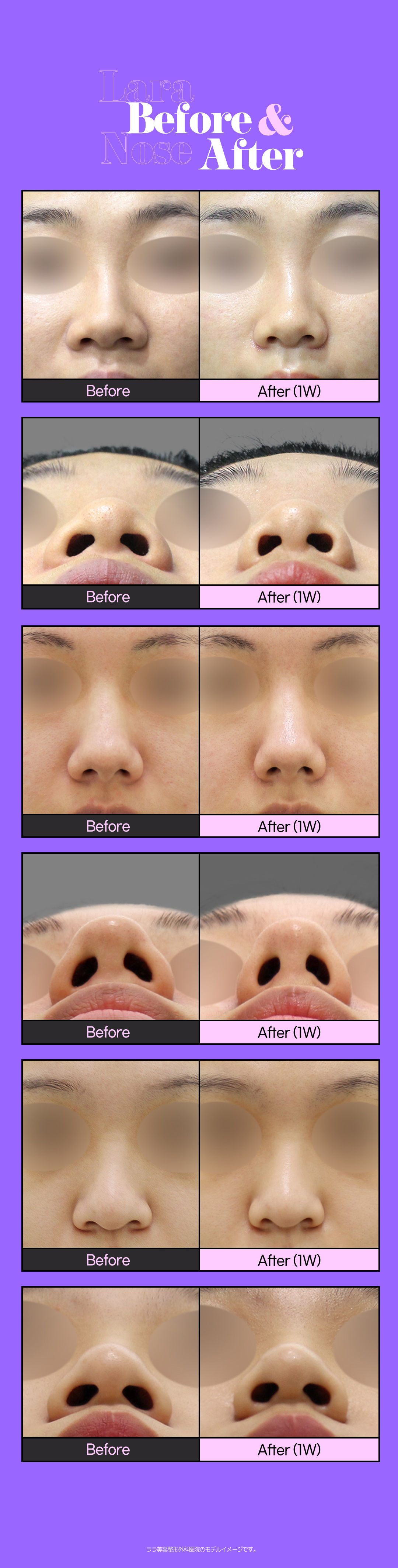 Thu nhỏ cánh mũi không cắt | Thu nhỏ cánh mũi bằng chỉ sẹo khó thấy | Lala Thẩm mỹ Gangnam Seoul