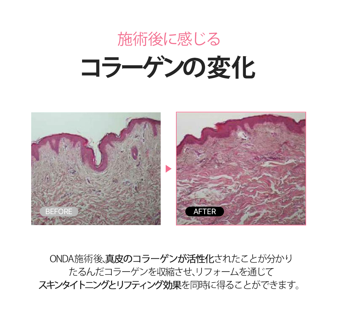 ONDA Body Lifting｜Nhắm đến body đàn hồi bằng sóng cực ngắn không phẫu thuật｜Phòng khám Cheongdam Dear Cheongdam-dong