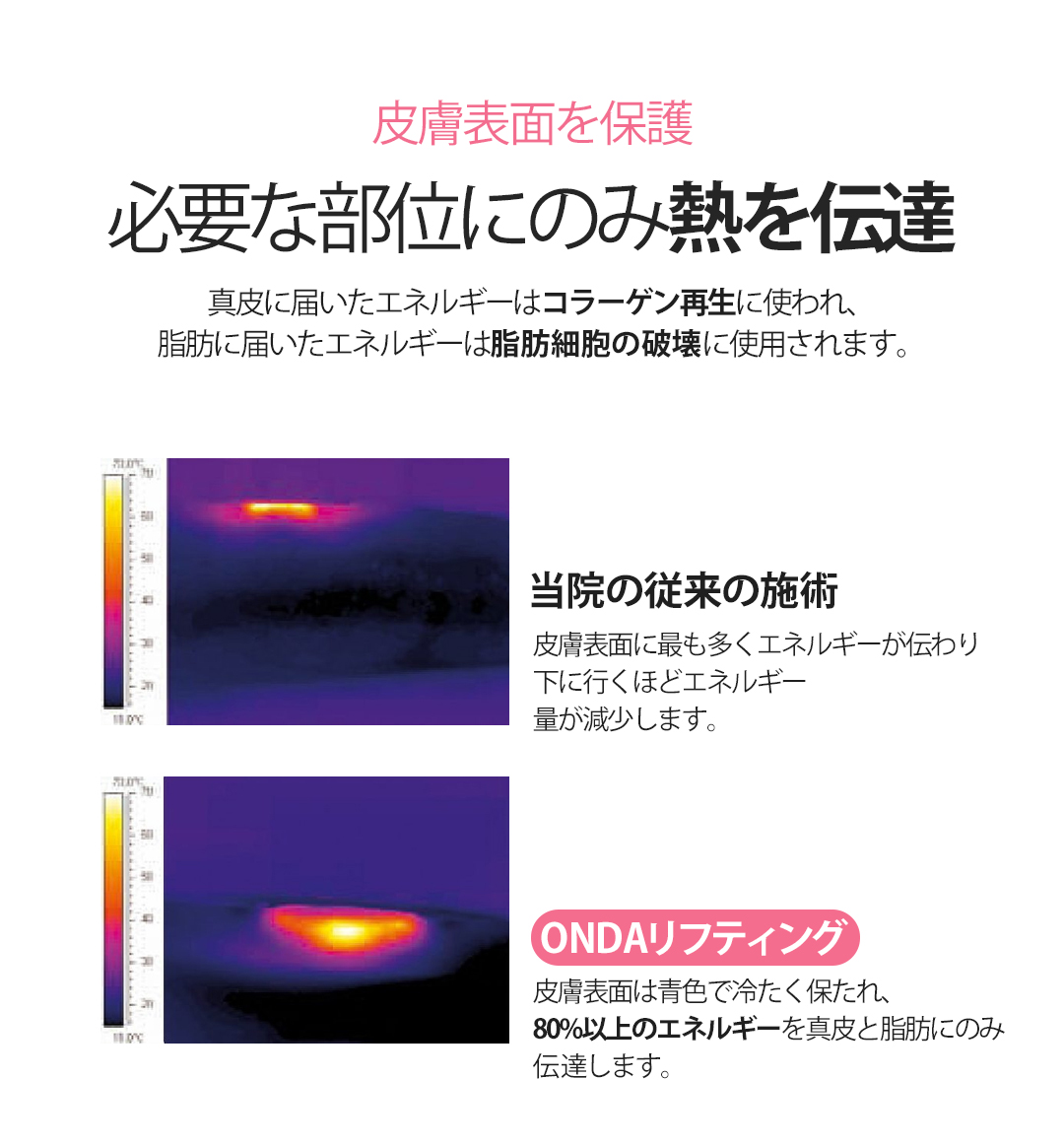 ONDA Body Lifting｜Nhắm đến body đàn hồi bằng sóng cực ngắn không phẫu thuật｜Phòng khám Cheongdam Dear Cheongdam-dong