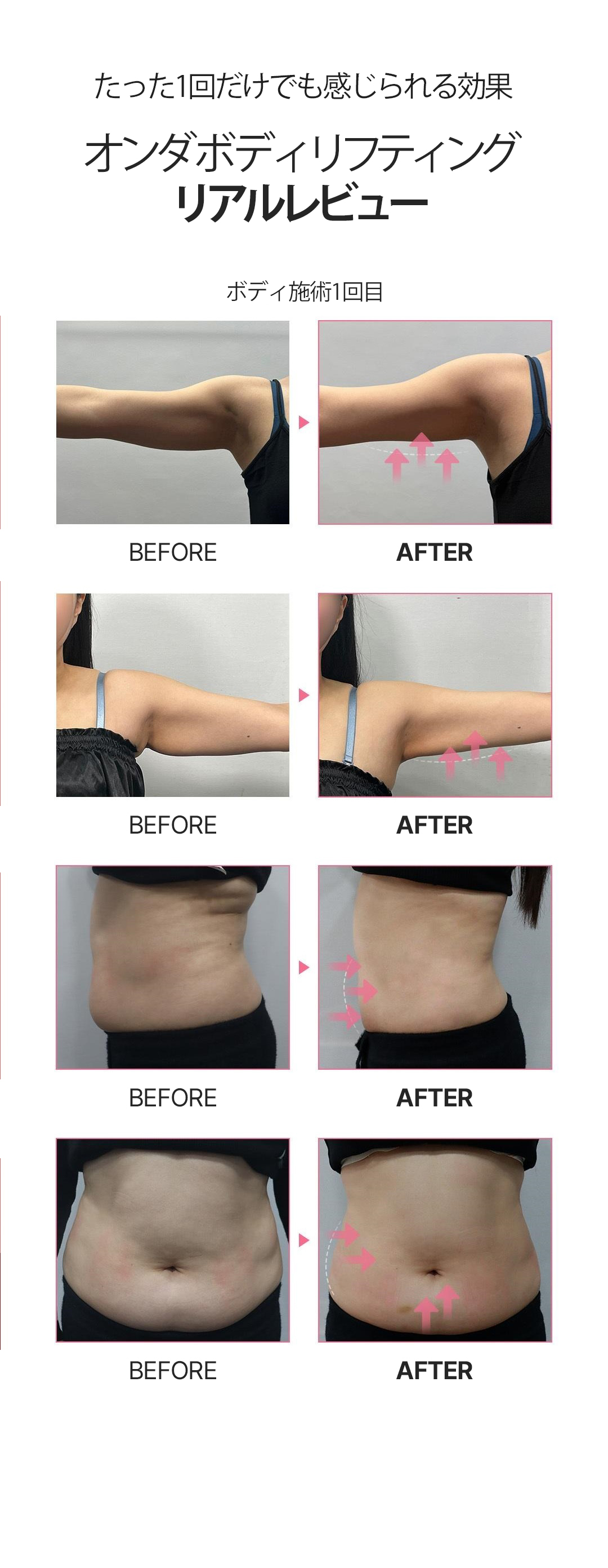 ONDA Body Lifting｜Nhắm đến body đàn hồi bằng sóng cực ngắn không phẫu thuật｜Phòng khám Cheongdam Dear Cheongdam-dong