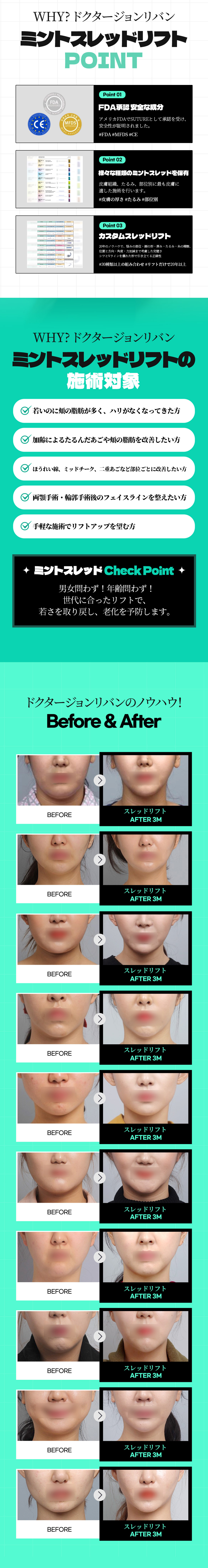 Chỉ nâng Mint Thread | Cải thiện chảy xệ với chỉ FDA chứng nhận | Seoul ga Apgujeong・Phòng khám Dr. Chung Reban