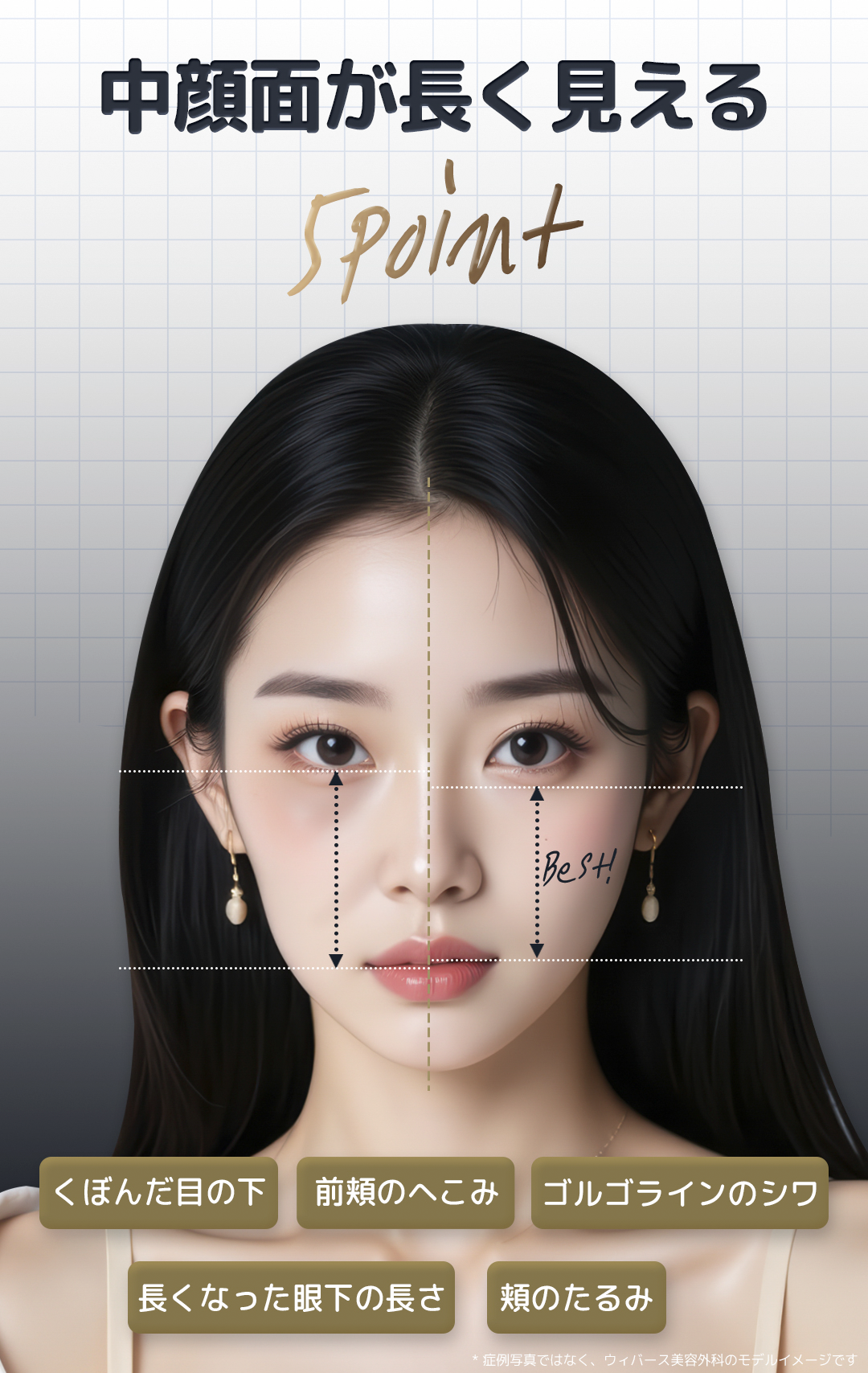 Căng da giữa mặt｜Cải thiện chảy xệ, rãnh lệ｜Phẫu thuật thẩm mỹ Hàn Quốc tại Viện thẩm mỹ Webers