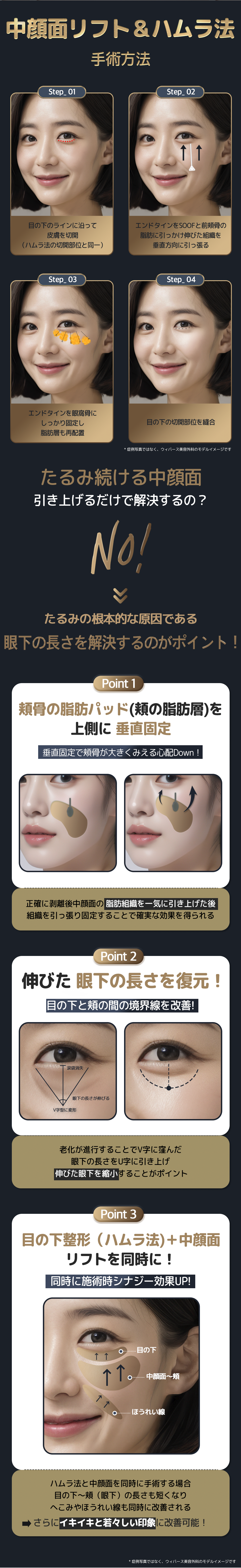 Căng da giữa mặt｜Cải thiện chảy xệ, rãnh lệ｜Phẫu thuật thẩm mỹ Hàn Quốc tại Viện thẩm mỹ Webers