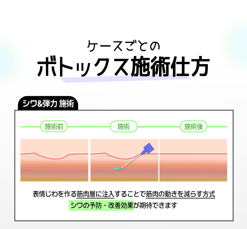 WJ Wonjin Phẫu thuật Thẩm mỹ ga Gangnam Hàn Quốc｜Botox nếp nhăn từ 7.700 won thủ thuật tiêm hướng đến cải thiện nếp nhăn biểu cảm