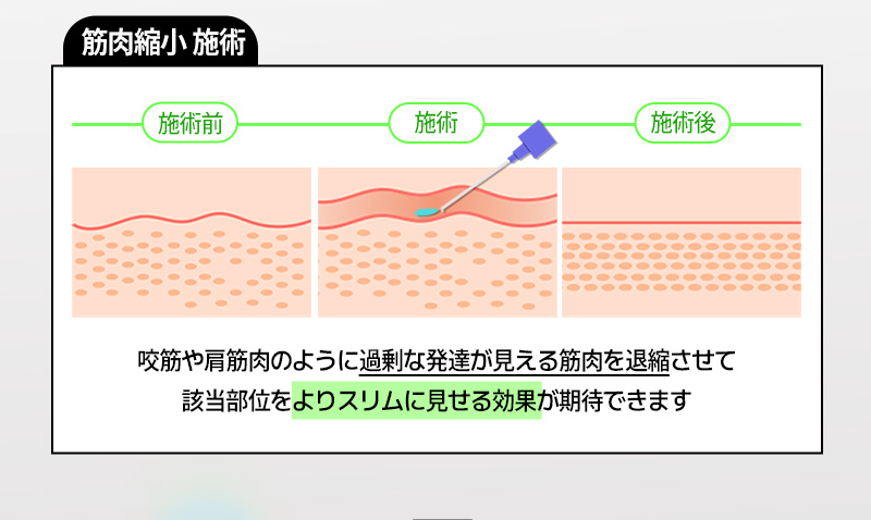 Botox hàm 50 đơn vị Hàn Quốc 2.165 yên｜WJ Wonjin Phẫu thuật Thẩm mỹ Gangnam hướng đến chăm sóc gọn mặt｜Thủ thuật an tâm sản phẩm chính hãng đúng liều lượng