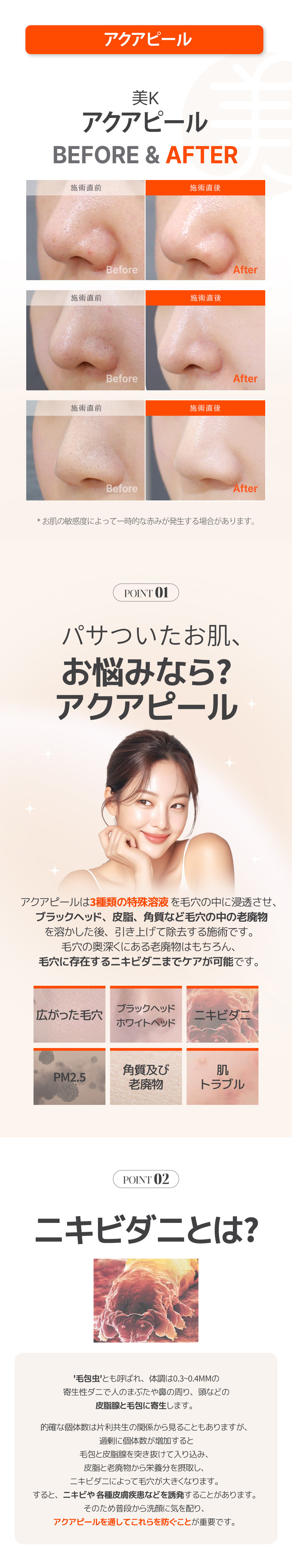 Gói chăm sóc mụn・lỗ chân lông | Aqua Peel × Laser Toning × Fraxel | Phòng khám Mikei ga Gangnam Seoul