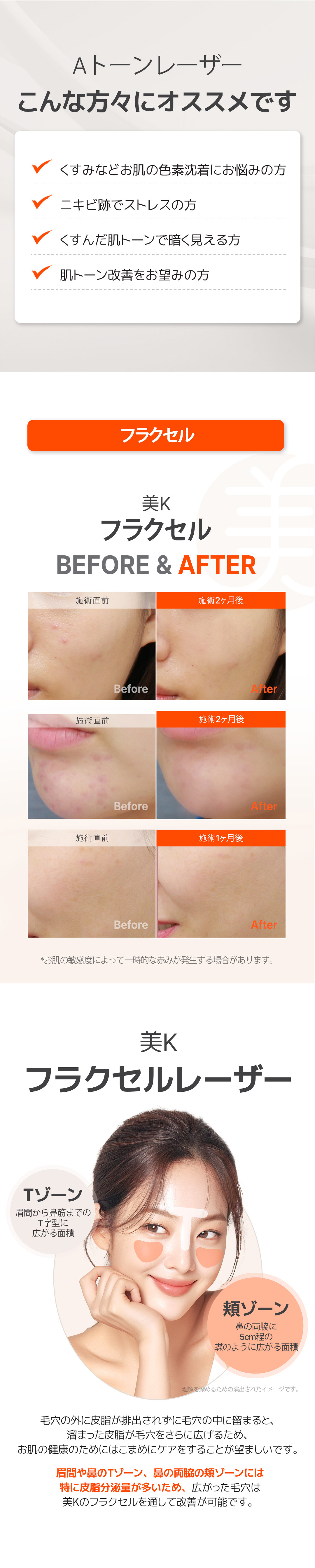 Gói chăm sóc mụn・lỗ chân lông | Aqua Peel × Laser Toning × Fraxel | Phòng khám Mikei ga Gangnam Seoul