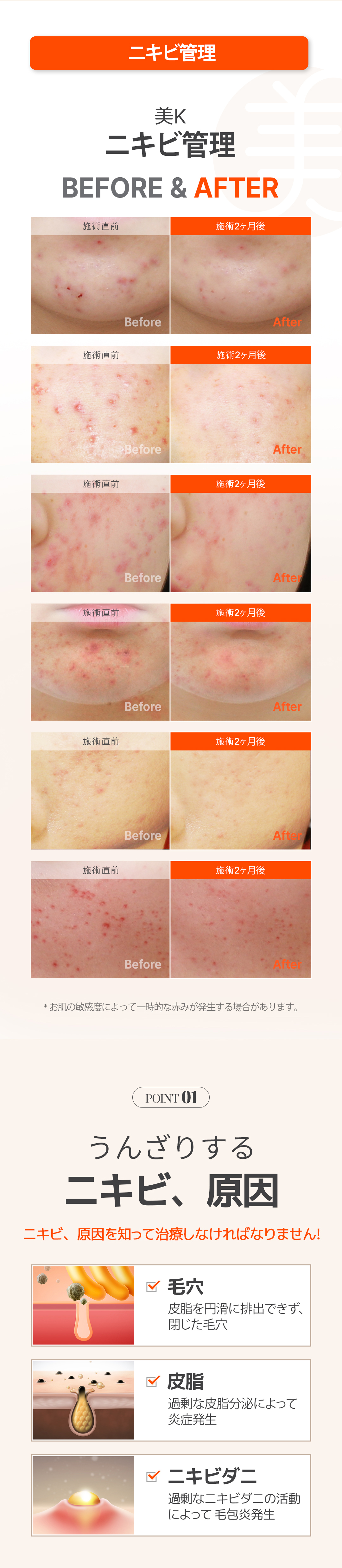 Gói chăm sóc mụn・lỗ chân lông | Aqua Peel × Laser Toning × Fraxel | Phòng khám Mikei ga Gangnam Seoul