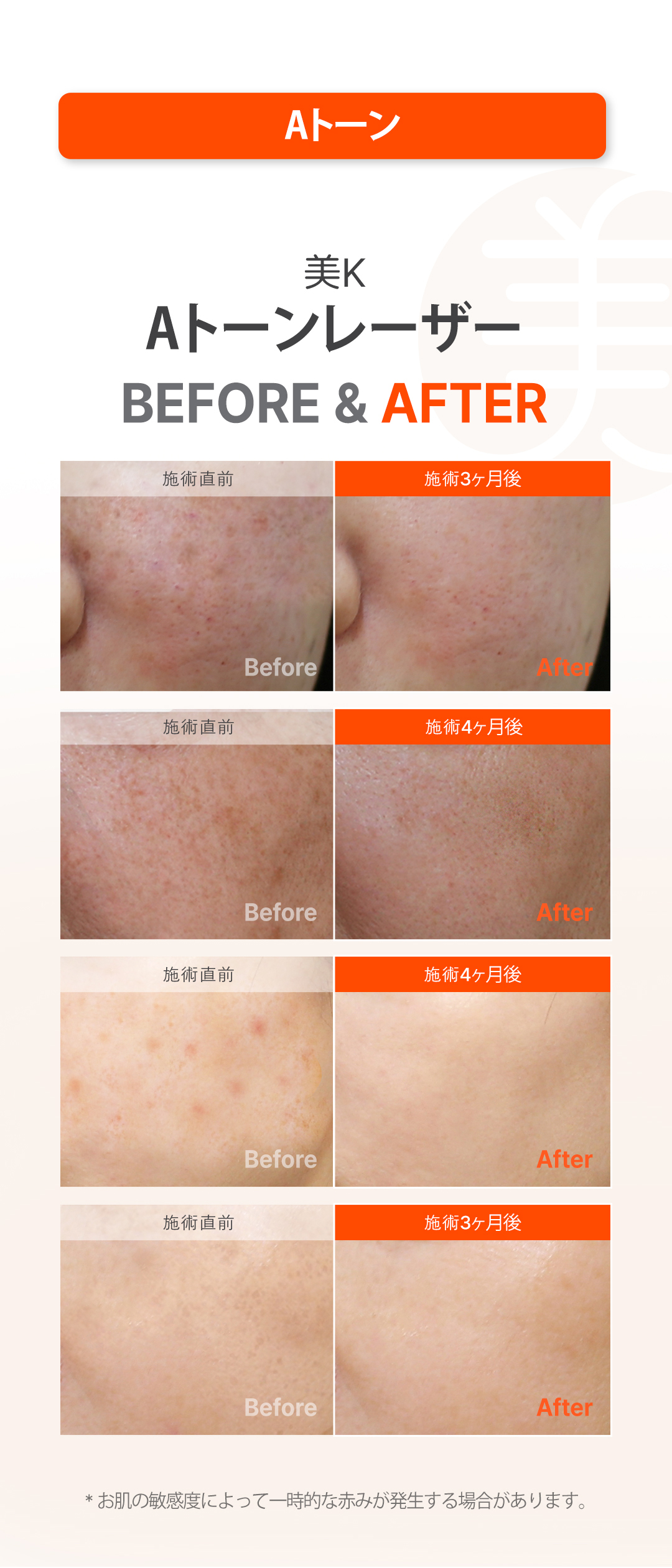 Gói chăm sóc mụn・lỗ chân lông | Aqua Peel × Laser Toning × Fraxel | Phòng khám Mikei ga Gangnam Seoul