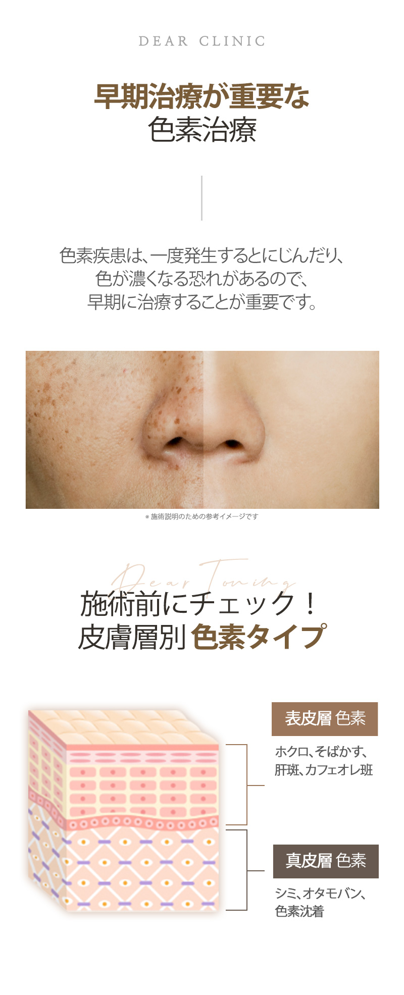 Laser xóa nám Dear