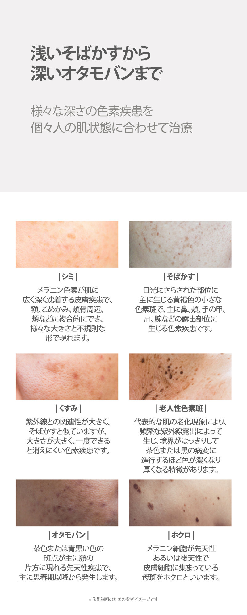 Laser xóa nám Dear