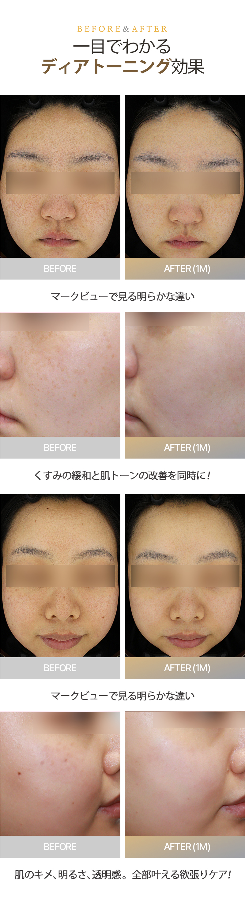 Laser xóa nám Dear