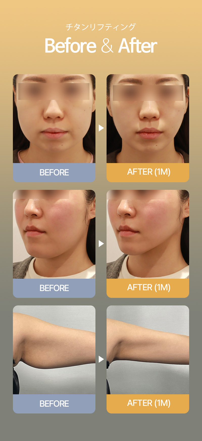 Titanium Lifting 80kj | Laser 3 bước sóng nâng cơ, trắng sáng, chăm sóc lỗ chân lông đồng thời | Phòng khám Cheongdam Dia