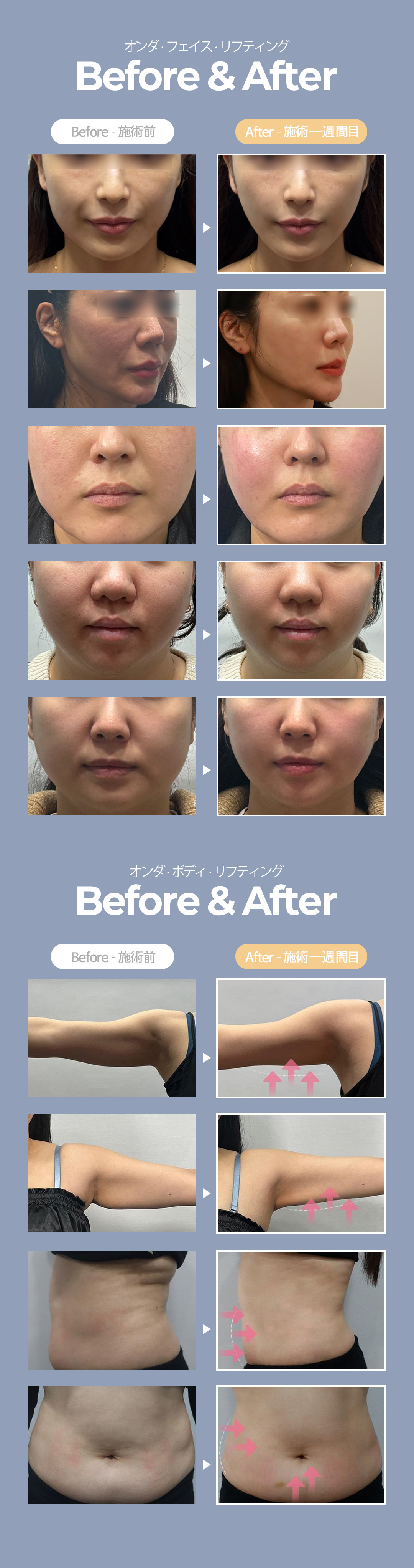 Onda Lifting 60kj | Liệu pháp nâng cơ không xâm lấn không cần gây tê | Phòng khám Cheongdam Dear