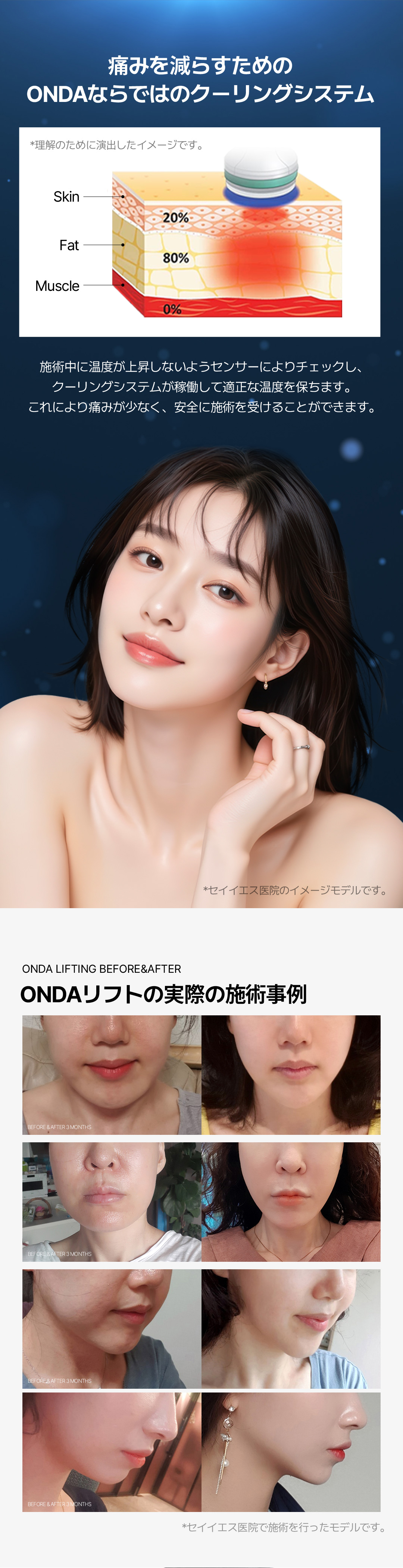 ONDA Lift | Microwave Lifting giảm đau chăm sóc độ đàn hồi và đường viền - Say Yes Clinic (ga Sinnonhyeon)