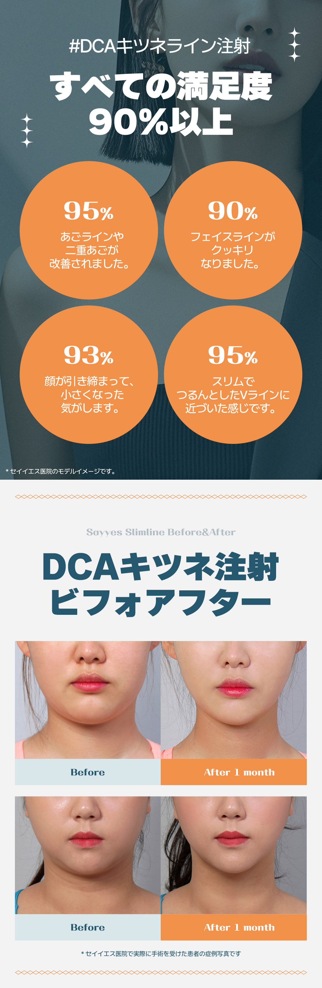 Tiêm tan mỡ DCA (tiêm Kitsune Line) cải thiện cằm đôi và đường viền mặt｜Seiyes Clinic・Seoul Gangnam