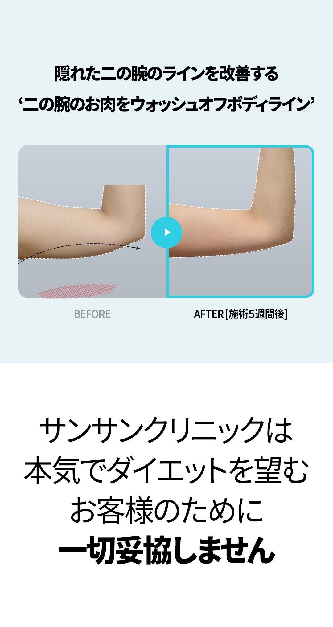 Tiêm tan mỡ bắp tay MPL Fit｜Dung lượng lớn cải thiện đường viền bắp tay｜Sansang Clinic Sinsa