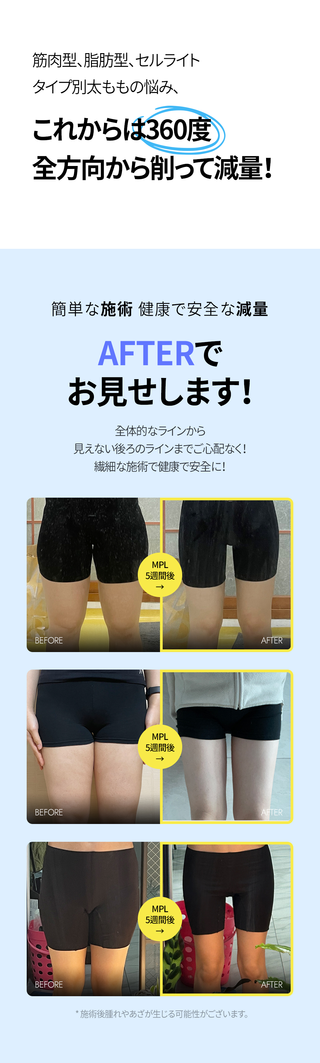 Tiêm tan mỡ MPL giảm mỡ cục bộ đùi 360 độ｜Dung lượng không giới hạn・có bằng sáng chế｜Sansang Clinic Sinsa