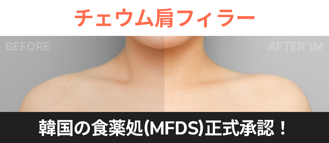 Filler vai Chaeum được Cục Quản lý Thực phẩm và Dược phẩm Hàn Quốc chứng nhận｜Hướng đến vai vuông・hiệu quả mặt nhỏ｜Phòng khám May Fill Gangnam