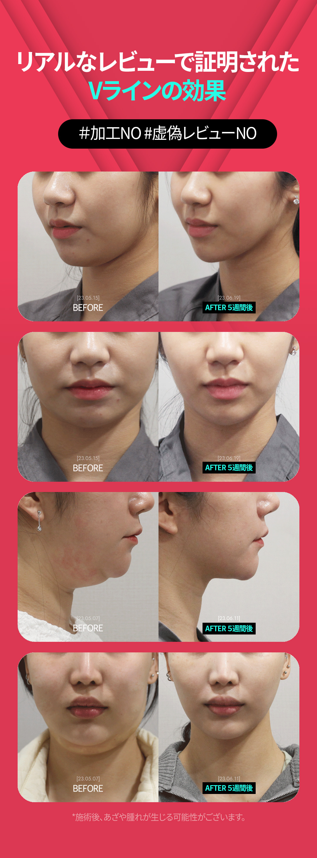 Tiêm tan mỡ mặt V-MPL hướng tới gương mặt nhỏ｜Tiêm tan mỡ có bằng sáng chế｜Seoul Sansang Clinic Sinsa