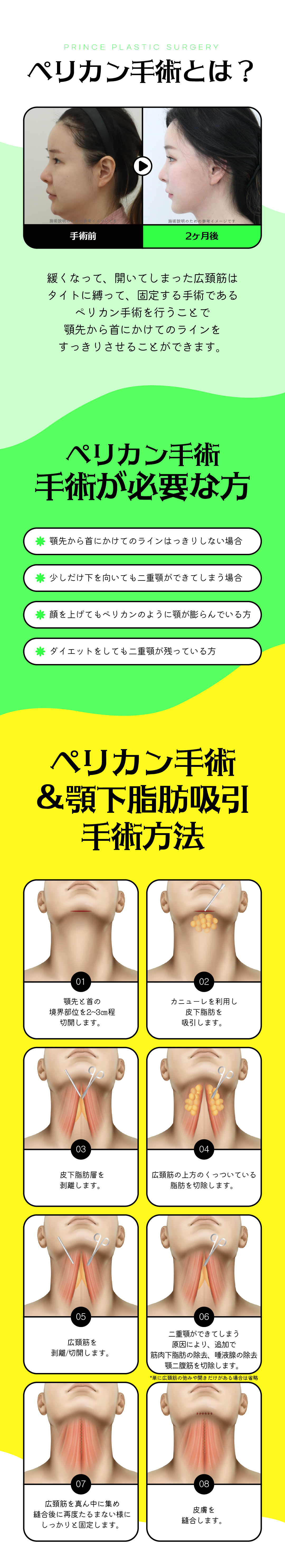 Phẫu thuật Pelican cải thiện cằm đôi｜Buộc cơ rộng cổ tạo đường viền cằm gọn gàng｜Seoul Sinsa Prince Plastic Surgery