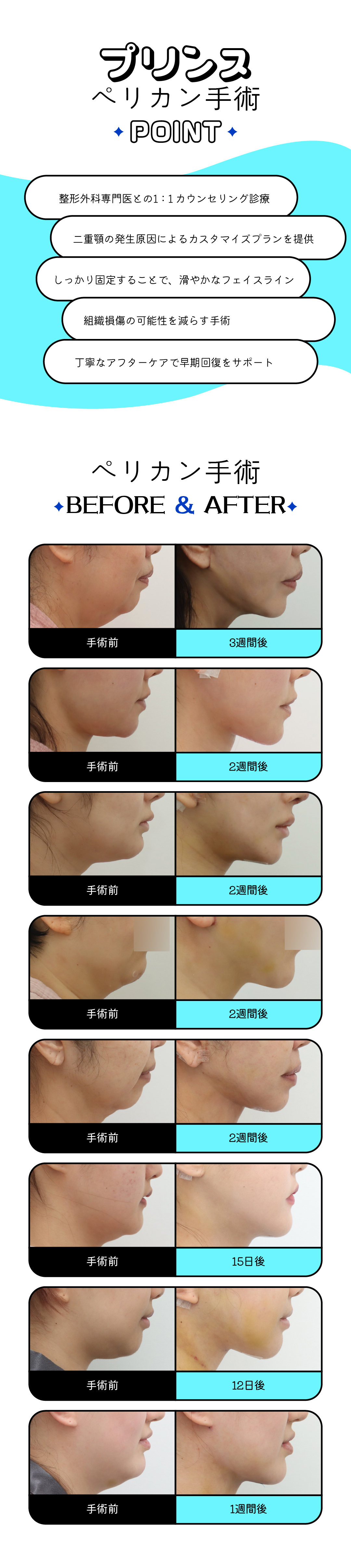 Phẫu thuật Pelican cải thiện cằm đôi｜Buộc cơ rộng cổ tạo đường viền cằm gọn gàng｜Seoul Sinsa Prince Plastic Surgery