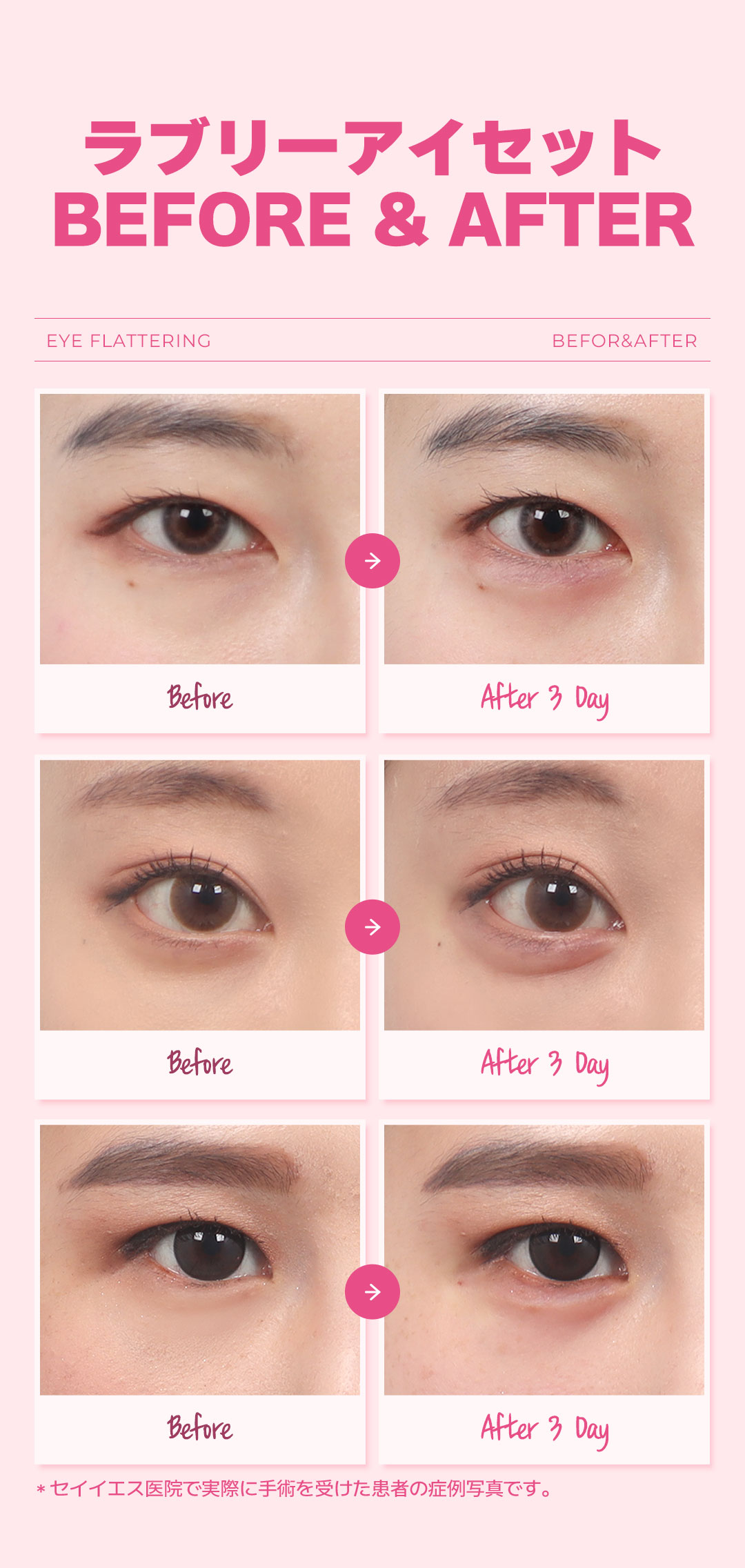 Bộ Lovely Eye kết hợp Filler túi lệ + Botox vùng mắt｜Thủ thuật hướng đến vùng mắt đáng yêu｜Phòng khám Say Yes Gangnam
