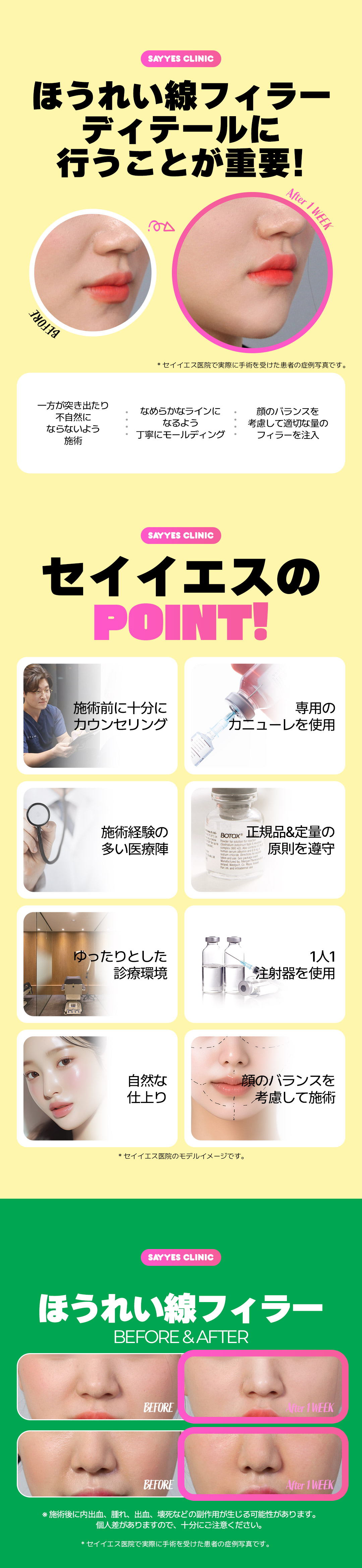 Thủ thuật filler rãnh mũi miệng Phòng khám Say Yes Seoul｜Hướng đến kết quả tự nhiên trong khoảng cách đi bộ từ ga Sinnonhyeon