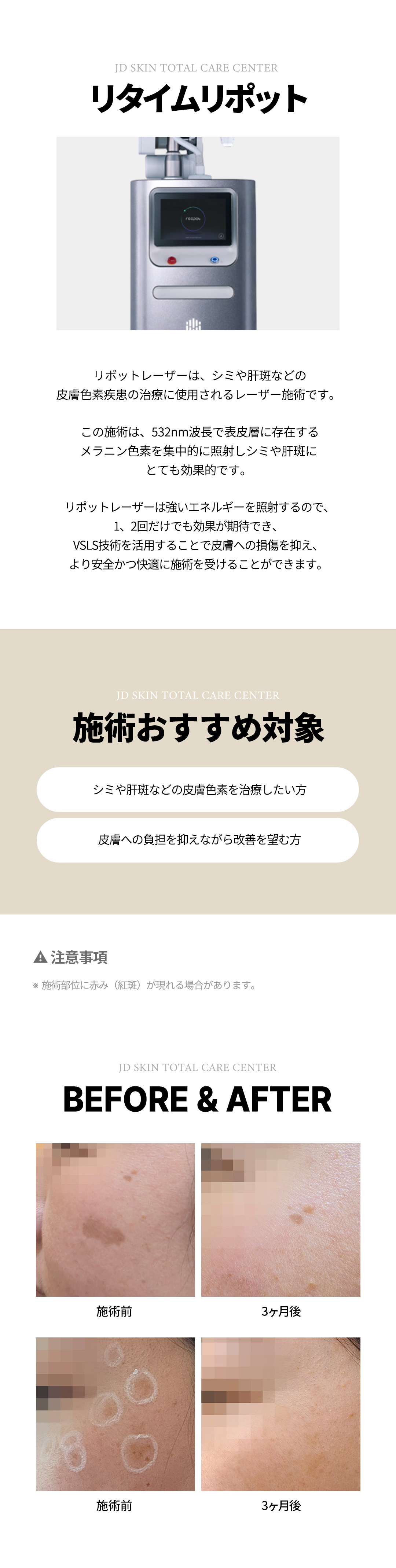 Xóa nám cứng đầu, nám gan, sắc tố