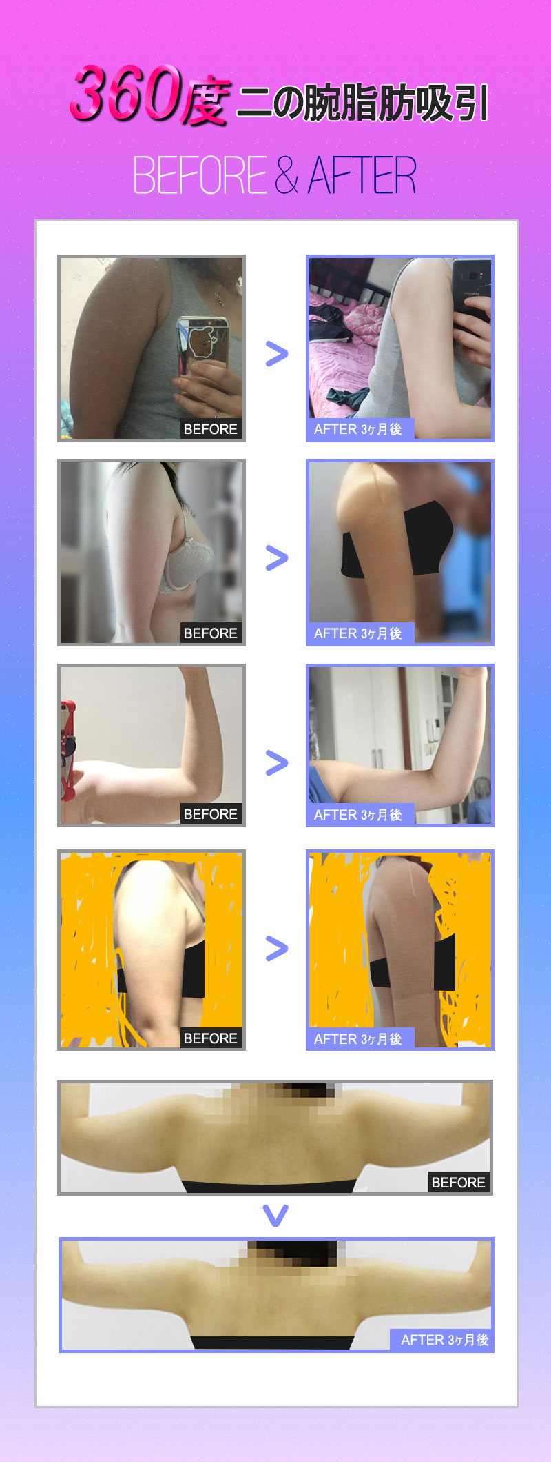 Hút mỡ bắp tay 360 độ hướng đến đường nét thon gọn lý tưởng | Bao gồm phí gây mê từ 990,000 won | WIZ&MI Clinic | Seoul Myeongdong