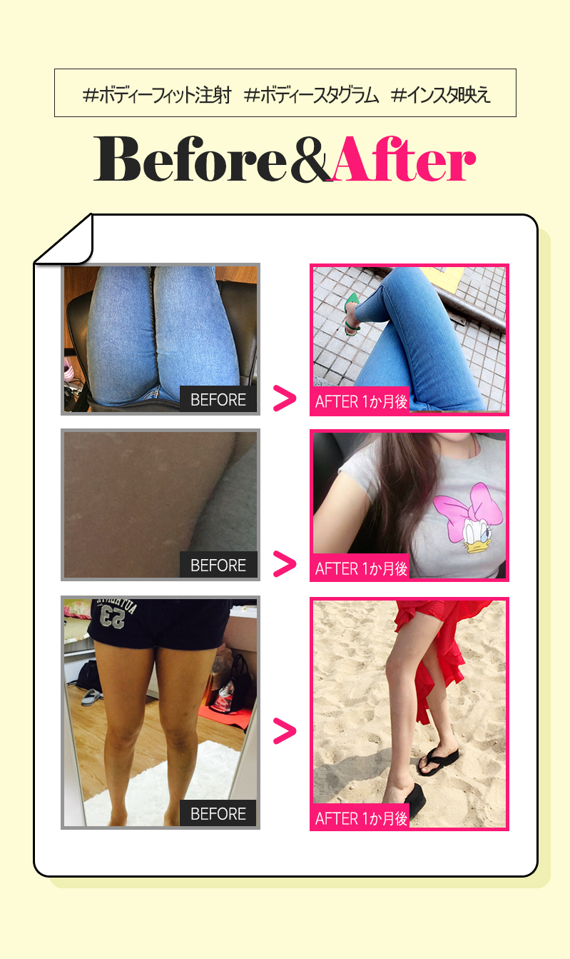 Tiêm tan mỡ Body Fit | Cải thiện đường cong cơ thể không cần rạch | WIZ&MI Myeongdong