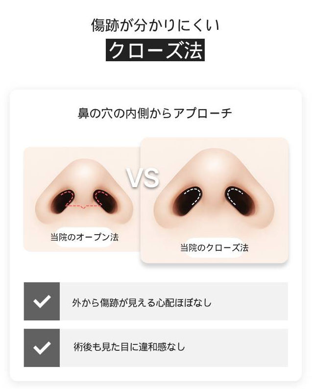 Tiêm Soft Nose | Nâng mũi tự nhiên bằng sụn tự thân・thời gian hồi phục 3 ngày | Seoul Gangnam Bệnh viện GNG