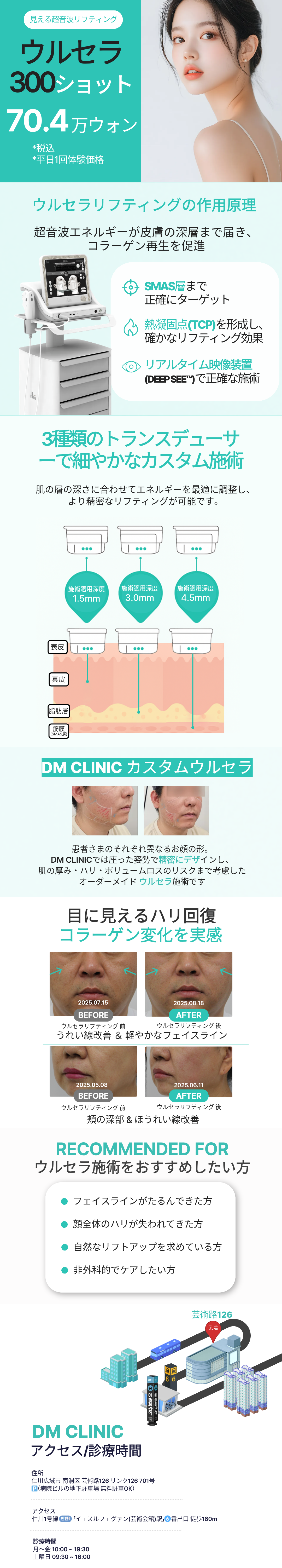 Ulthera Lifting 300 Shot｜Viện Dermatist Incheon｜Y tế thẩm mỹ Hàn Quốc hướng đến cải thiện đường viền mặt tự nhiên