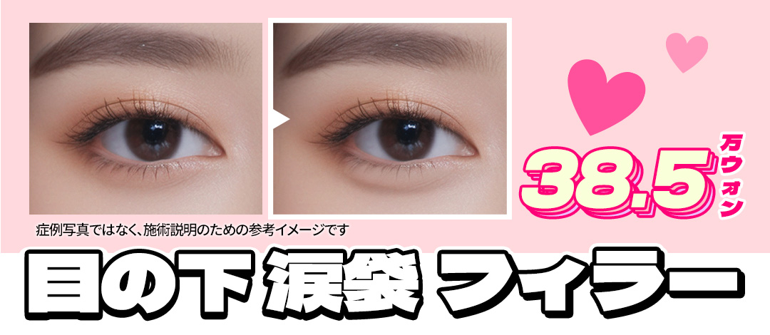 Filler túi lệ hướng đến vùng mắt trẻ thơ tự nhiên｜Sử dụng kim cannula giảm đau｜Seoul Hongik Univ. stn.・Phòng khám Jfeel Hongdae